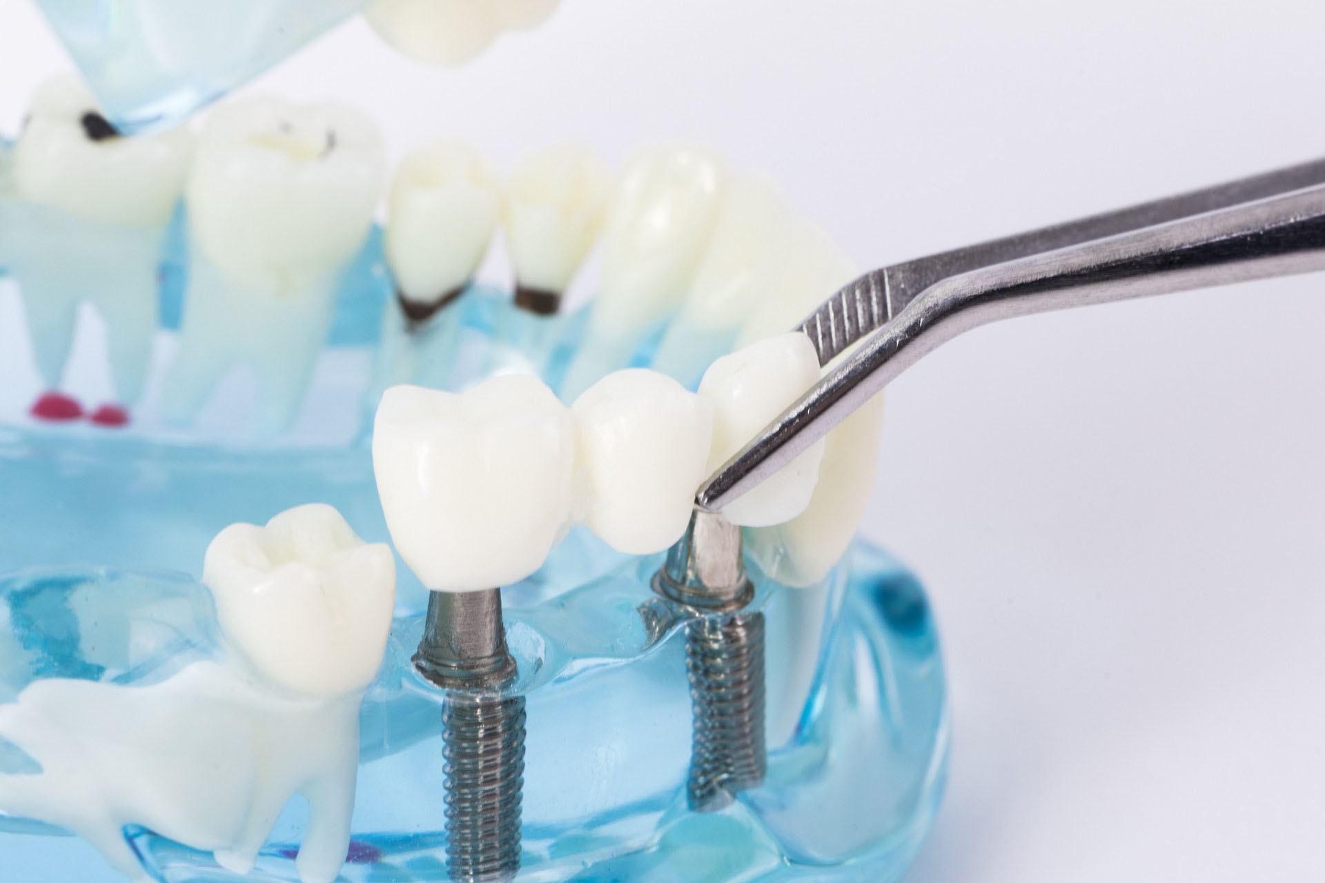 拔牙后绝对不能做的事！